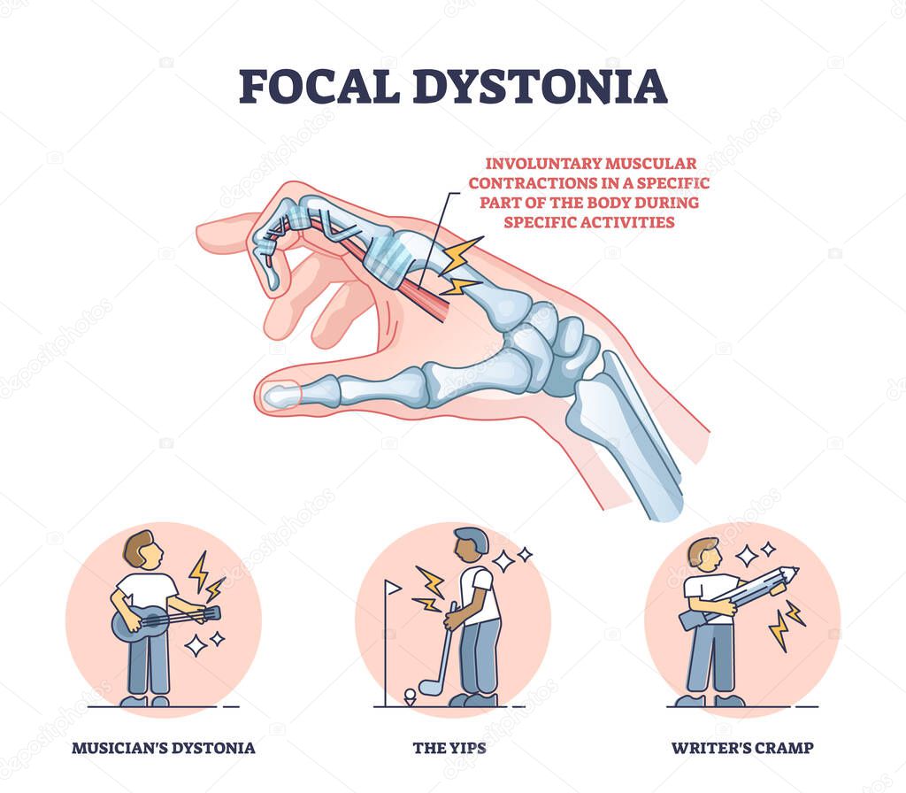 Focal dystonia as anatomical neurological muscle disorder outline diagram. Labeled educational medical explanation with involuntary muscular contractions in specific body part vector illustration.