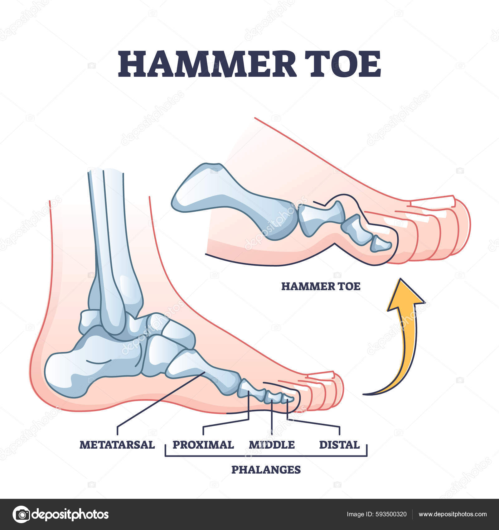 Hammer Toe Medical Problem Anatomy Foot Phalanges Deformation Outline