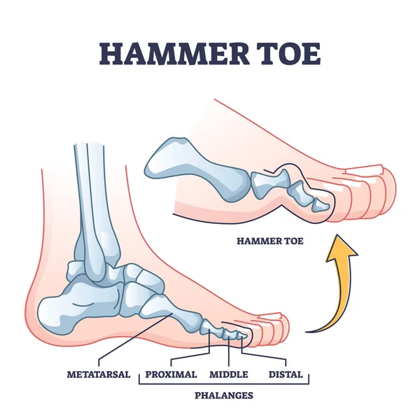 Hammer Toe Medical Problem Anatomy Foot Phalanges Deformation Outline Diagram — ストックベクタ