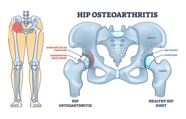 Hip osteoartrit kemik hastalığı ve acı veren iskelet çizelgesi. Osteofit hasarlı leğen kemiği ve uyluk anatomisi çizimi ile etiketlenmiş eğitim şeması. İltihap hastalığı..