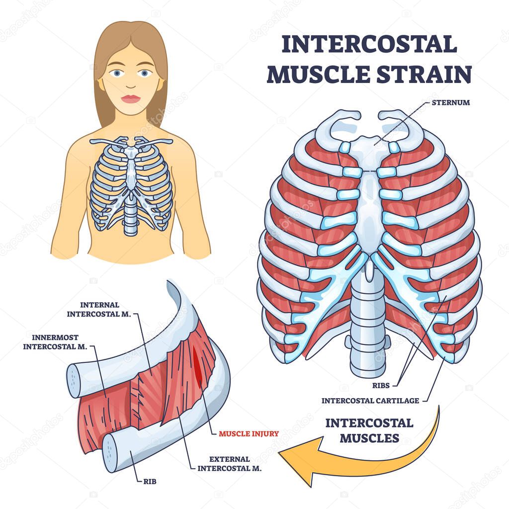 Intercostal muscle strain as muscular group in chest cavity outline diagram. Labeled educational medical scheme with skeleton and lungs muscle for ribcage respiratory movement vector illustration.