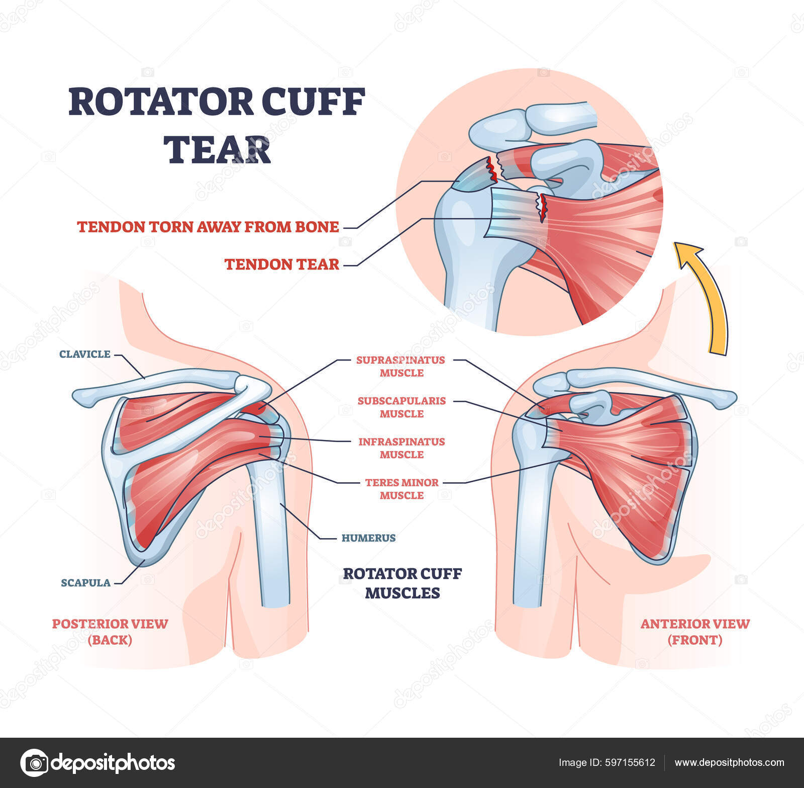 Rotator Cuff Tear Shoulder Muscle Trauma Arm Injury Outline Diagram