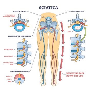 Sciatica pain or nerve weakness as leg lumbar radiculopathy outline diagram. Labeled educational back inflammation, piriformis syndrome and degenerative spinal disc problem vector illustration.