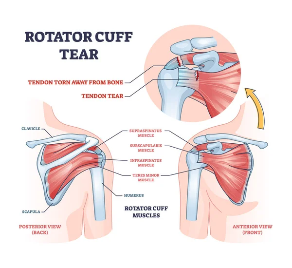 Rotator Cuff Tear Shoulder Muscle Trauma Arm Injury Outline Diagram — Stok Vektör