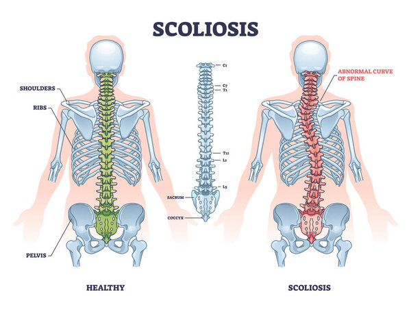Scoliosis as medical sideways curvature illness of spine outline diagram. Labeled educational scheme with healthy and abdominal backbone skeleton comparison vector illustration. Deformity posture.