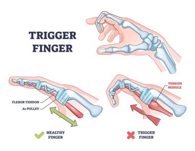 Trigger finger as finger stuck in bent position condition outline diagram. Labeled educational scheme with medical trauma with bending index finger, flexor tendon or pulley anatomy vector illustration clipart