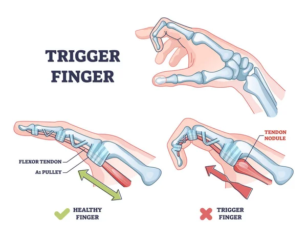 Trigger Finger Finger Stuck Bent Position Condition Outline Diagram Labeled — Stock Vector