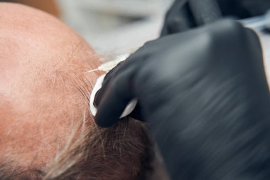 Güzellik uzmanı elleri insan kafasına iğne yapıyor.