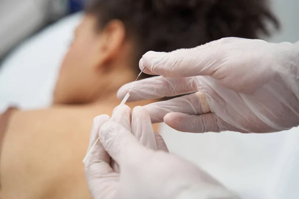 Trabajador médico preparándose para la sesión de acupuntura para relajar los músculos —  Fotos de Stock