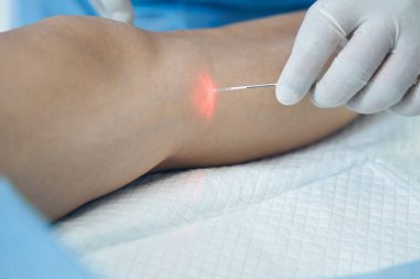 Lastik eldivenli bir doktorun elindeki lazer lifinin fotoğrafını kapat.