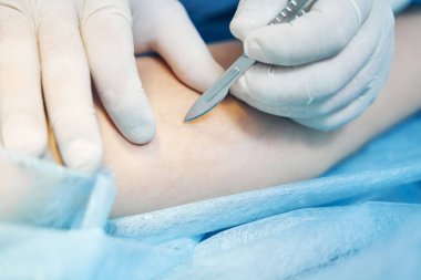 Bir hastanın kolunun kesilmiş fotoğrafı ve lateks eldivenli bir doktorun eli üzerine neşter koyması.