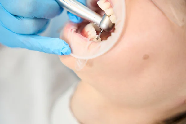 Taladro Las Manos Dentista Trata Paciente Dientes — Foto de Stock