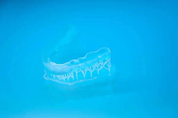 Impression of a clear aligner to correct an overbite