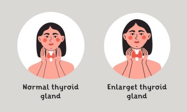 Normal ve tiroit bezini büyüt. Boynunda tiroid bezi olan bir kadın. Endokrinoloji sistemi sembolü, hormon üretiminden sorumlu organ. Düz vektör izole çizimi.