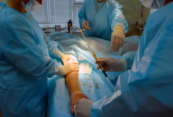 Cirugía Liposucción Cosmética Quirófano Real Mostrando Las Manos Cánula Del —  Fotos de Stock