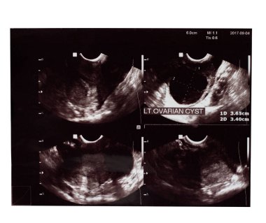 Film ultrasonu, yumurtalık kistleri, kadınlar için iç organ muayenesi.