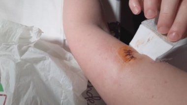 Evinde bir kadın kolundaki yara bandını çıkarmaya çalışıyor. Ameliyat sonrası oluşan bir yaranın melanomu almak için cerrahi dikişlerini gösteriyor..