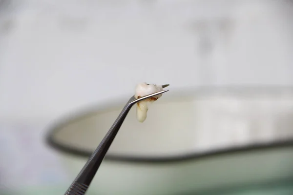 Dentist shows the extracted tooth in a tweezers