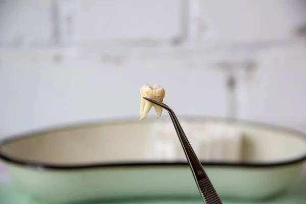 Dentist shows the extracted tooth in a tweezers