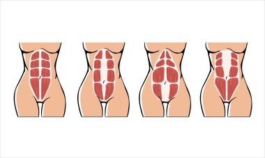 Farklı türde Diastasis. Hamilelikten sonra bir kadında hastalık. Kadın anatomisi. Doğumdan sonra kaslı bir kadın korsesi. Vektör illüstrasyonu