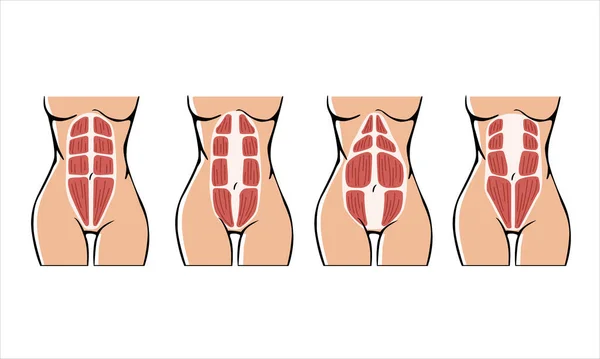 Diferentes Tipos Diástase Diastase Uma Mulher Após Gravidez Anatomia Feminina —  Vetores de Stock