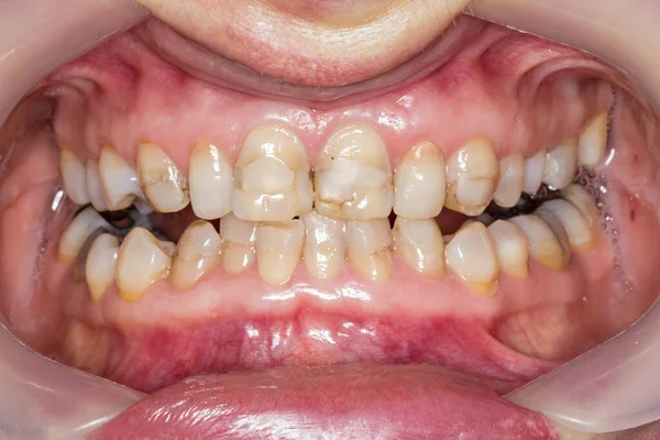 Dentes Partidos Sorriso Dentes Cavidade Oral — Fotografia de Stock