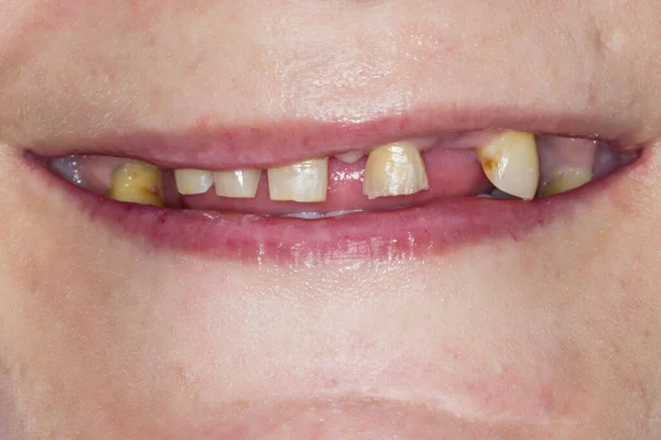 Denti Rotti Bocca Denti Stretti Sorriso Odontoiatria Carie — Foto Stock