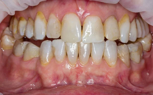 Dentes Partidos Boca Dentes Gritados Sorriso Odontologia Cárie Dentária — Fotografia de Stock
