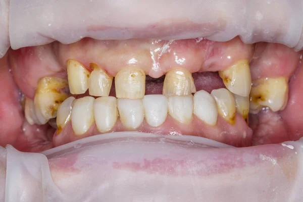 Сломанные Зубы Рот Стиснутые Зубы Улыбка Стоматология Кариес — стоковое фото