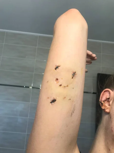 Dog bite of the upper arm and ear, triceps surgery, damaged ear in the back, reconstruction