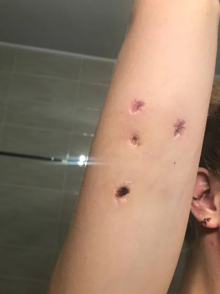 Dog bite of the upper arm, triceps surgery, stitches, blood, reconstruction