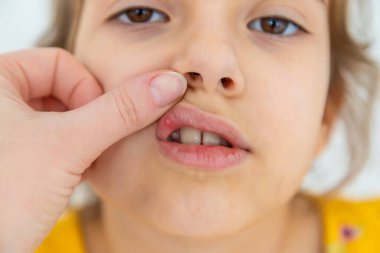 The child has stomatitis on the lip. Selective focus. Kid. clipart