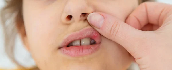 Criança Tem Estomatite Lábio Foco Seletivo Miúdo — Fotografia de Stock
