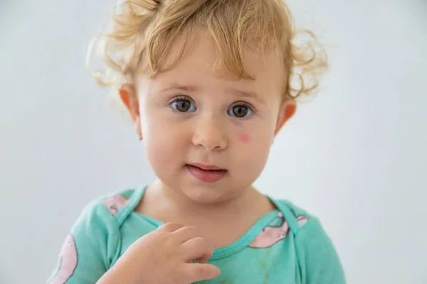 那孩子的脸被蚊子咬了 有选择的重点 — 图库照片