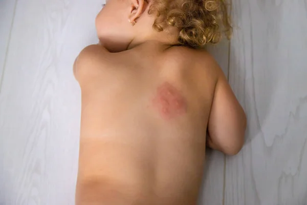 Mosquito Bites Child Back Selective Focus Kid — Fotografie, imagine de stoc