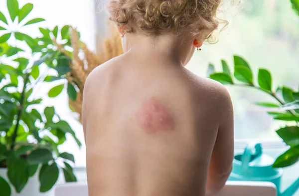 Mosquito Bites Child Back Selective Focus Kid — Fotografie, imagine de stoc