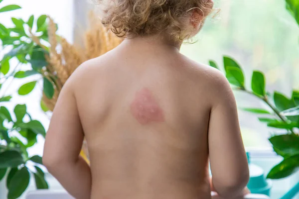 Mosquito Bites Child Back Selective Focus Kid — Fotografia de Stock
