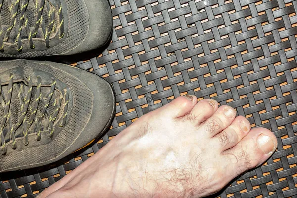 Ematoma Subunguale Unghie Dei Piedi Rotte Causa Camminare Correre Scarpe — Foto Stock