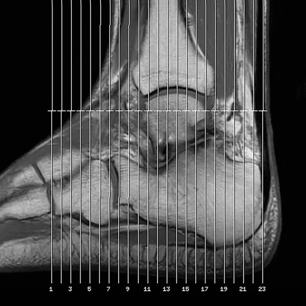 Magnetic Resonance Imaging Marked Measurement Lines Image Left Ankle Joint — Foto Stock