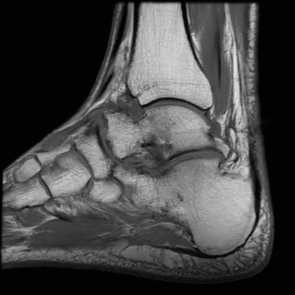 Magnetic resonance imaging - image of the left ankle joint after trauma and surgery.