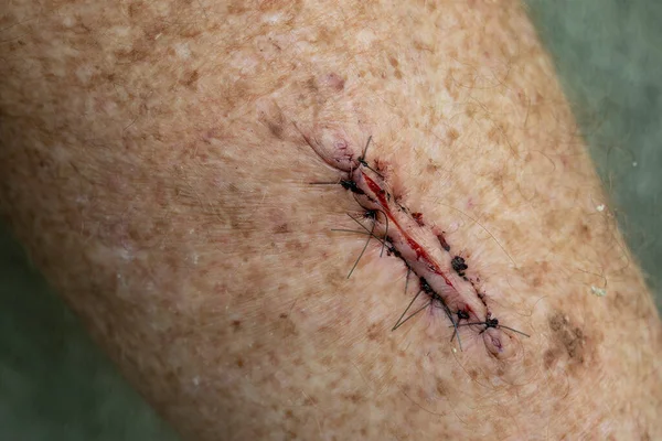 A surgical scar with sutures after the removal of a skin cancer from the leg of a senior male with sun damaged skin.