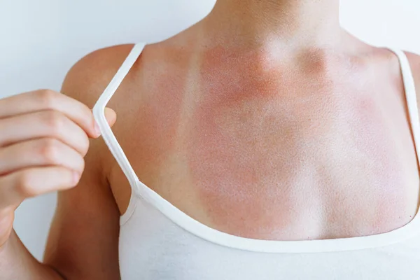 Sunburn Skin Traces Swimsuit Woman Has Sore Skin Redness Blisters — Stock Photo, Image