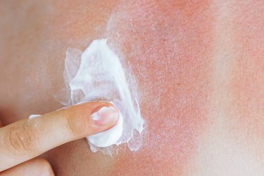 Güneşe maruz kalmanın sonuçları, kızarıklık, kabarcıklar, deri şişmesi, kayış yüzünden bronzlaşmamış deri izleri. Kadının eli güneş yanığı üstüne yanık önleyici krem sürüyor.