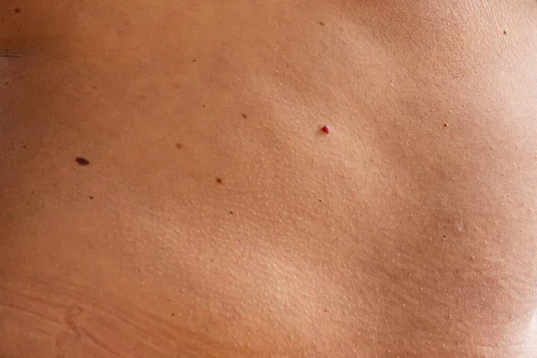 Close-up of bare skin on back with red and brown moles and age spots. Checking for benign moles. effect of sun on skin. Moles on skin