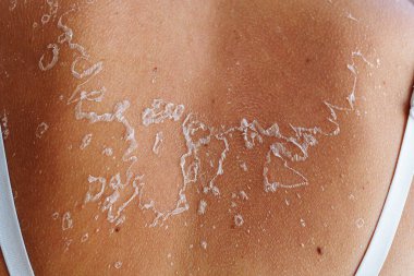 Back close-up with tank top straps, with sunburn, shabby flaky skin, reminiscent of outline of map of country Ukraine