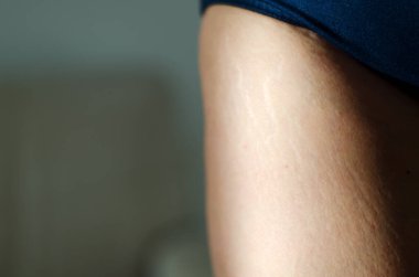 Stretch marks on legs after weight loss close up. Background and texture. Skin care. Active sport. Healthy lifestyle. Beauty. 