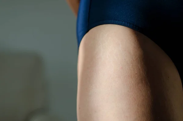 Stretch Marks Legs Weight Loss Close Background Texture Skin Care — Fotografia de Stock