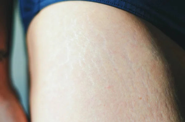 Stretch marks on legs after weight loss close up. Background and texture. Skin care. Active sport. Healthy lifestyle. Beauty.