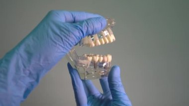 Diş hekiminin ellerine implant takılmış insan çene modeli. Diş implantı laboratuvarı.