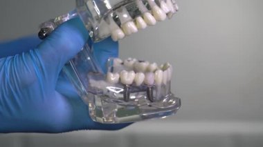 Diş hekiminin ellerine implant takılmış insan çene modeli. Diş implantı laboratuvarı.